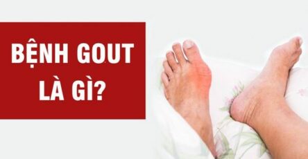 Gout là gì